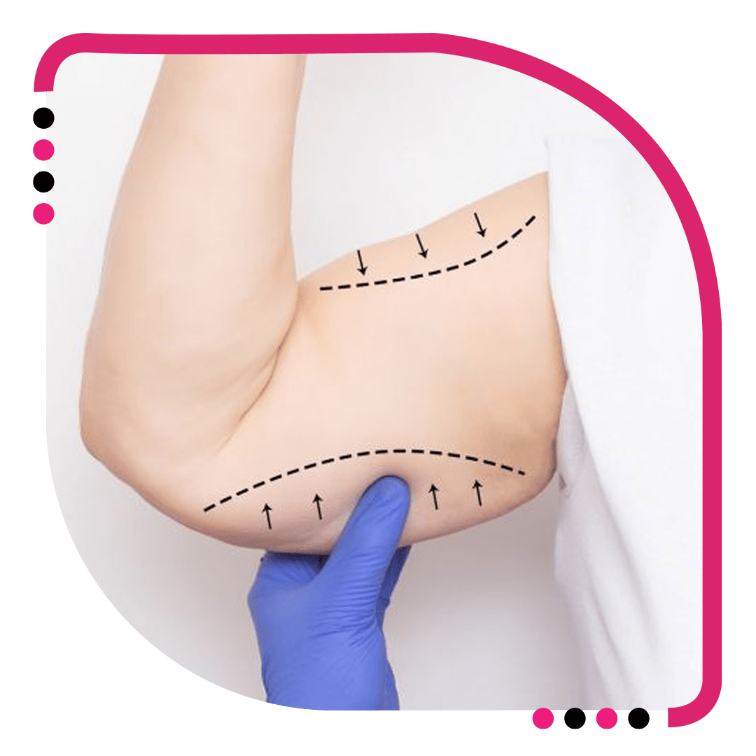 Arm Lift Surgery in Jalandhar