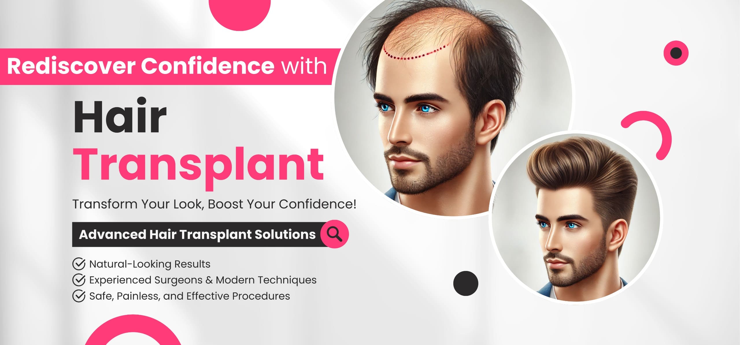 Hair Transplant